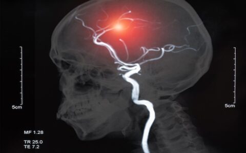Stroke brain-bleed deaths predicted to increase by 40% in the UK